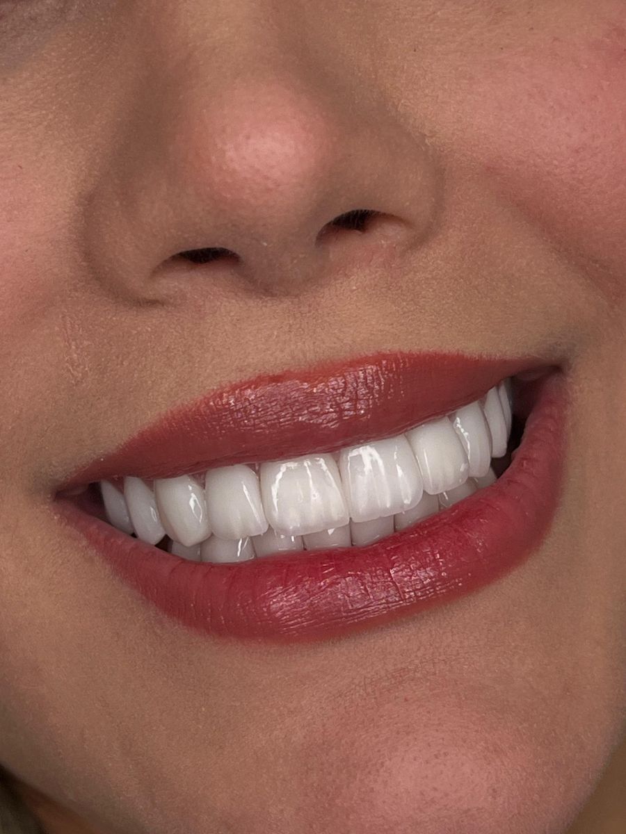Porcelain veneers case 1, after treatment