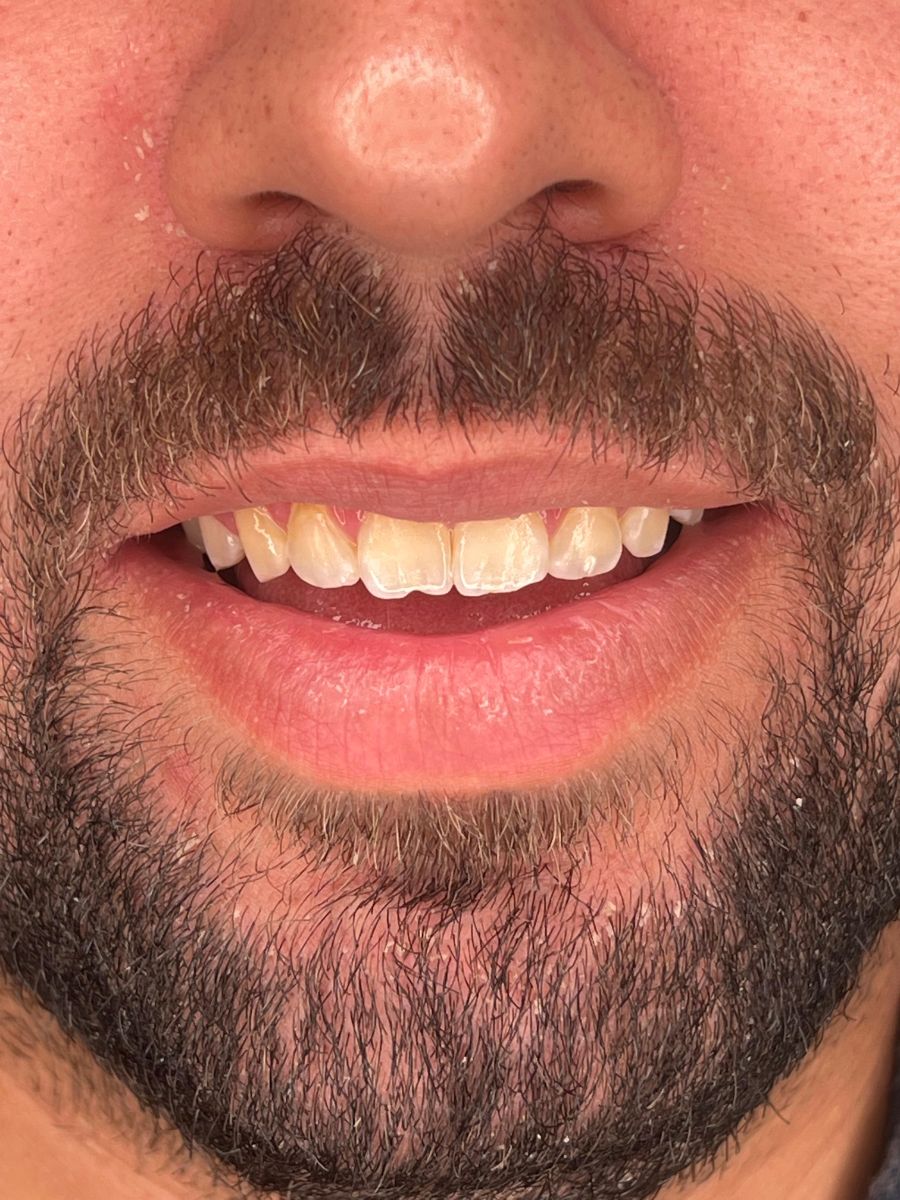 Porcelain veneers case 10, before treatment