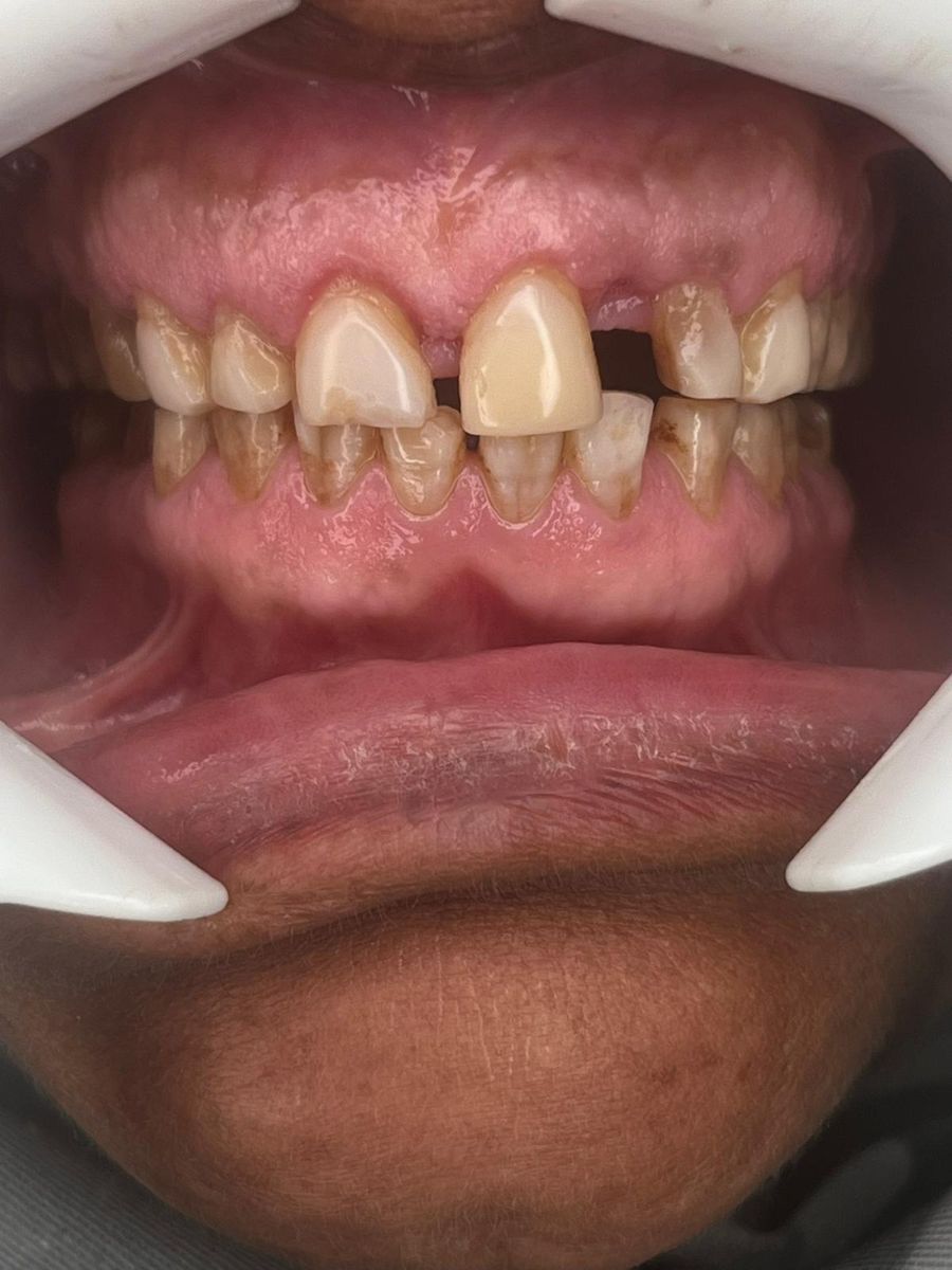 Porcelain veneers case 2, before treatment