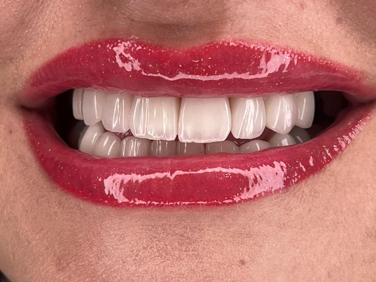 Porcelain veneers case 4, after treatment