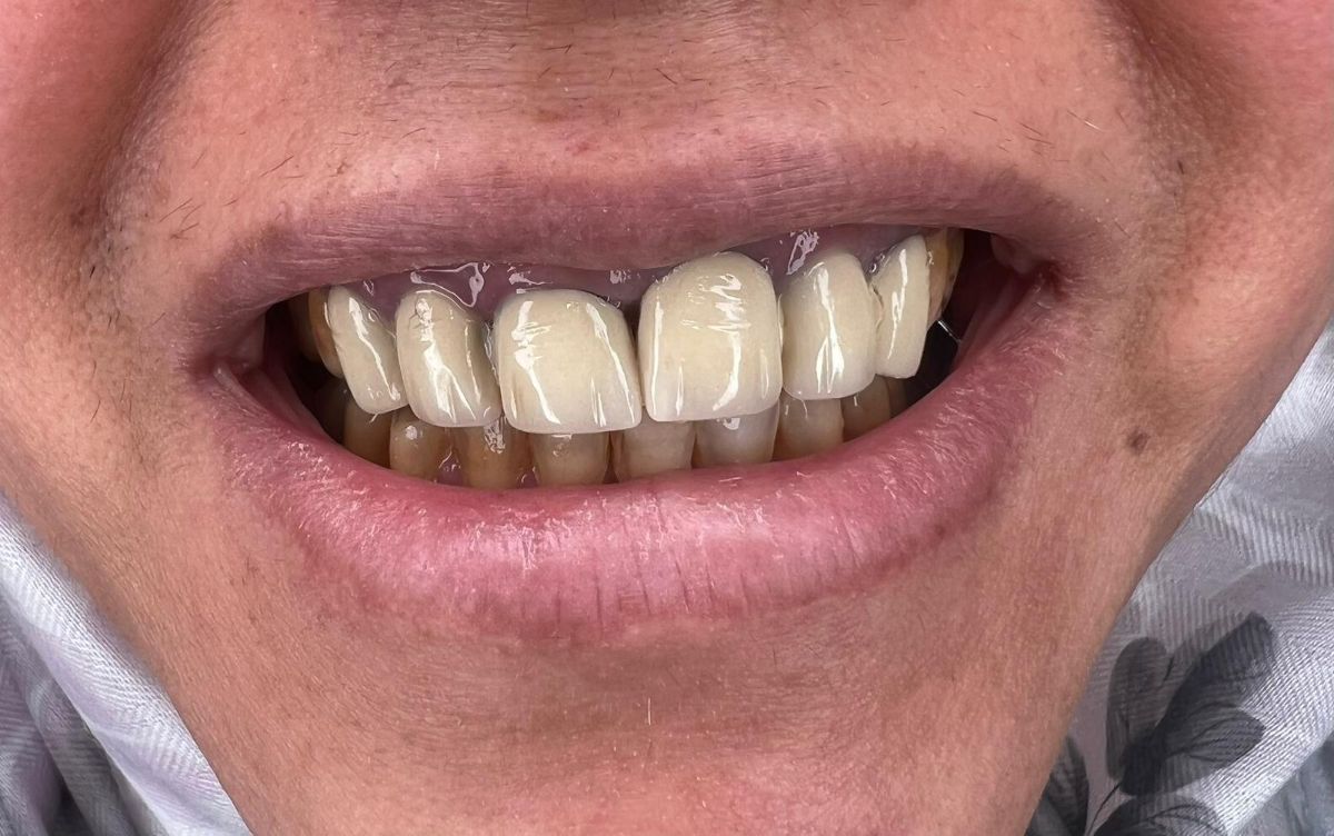 Porcelain veneers case 6, before treatment