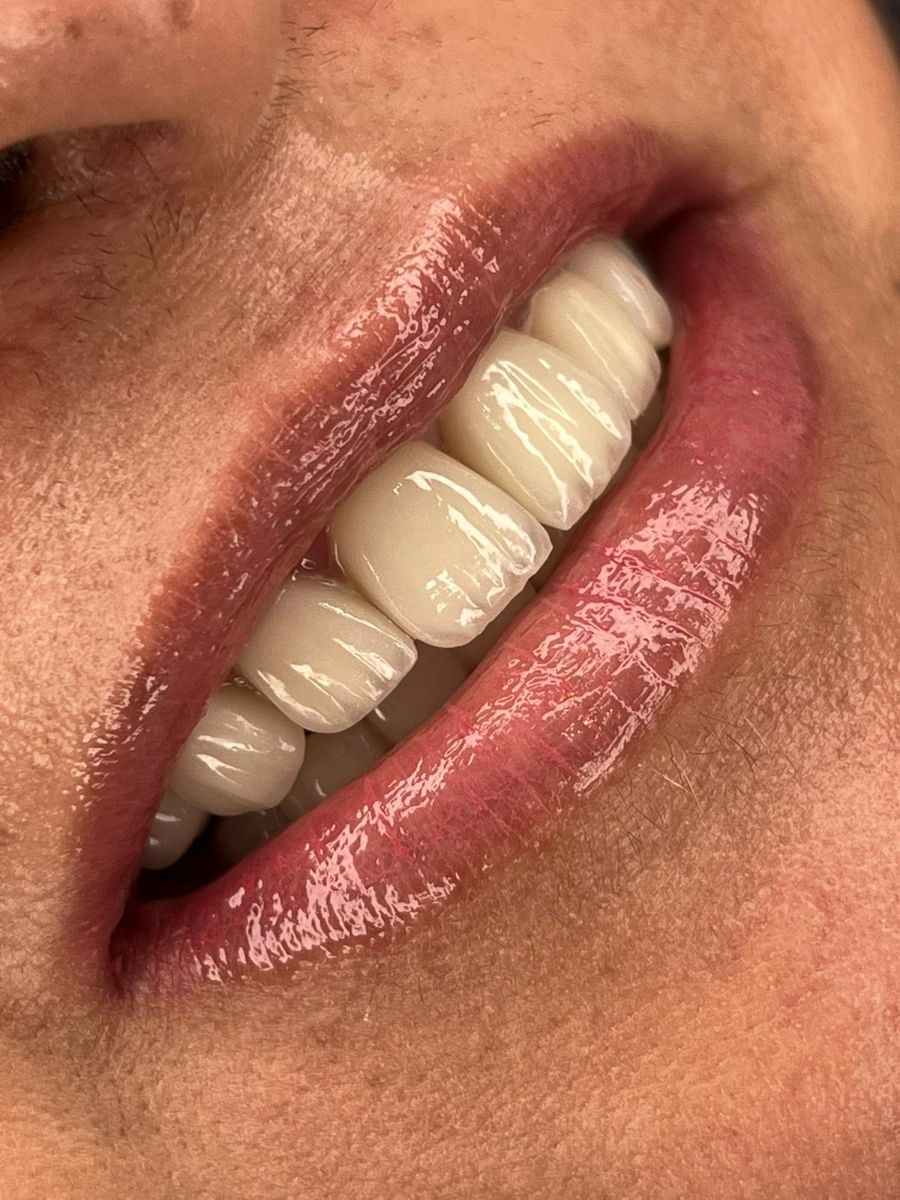 Porcelain veneers case 6, after treatment