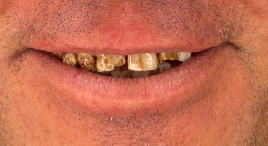 Porcelain veneers case 8, before treatment
