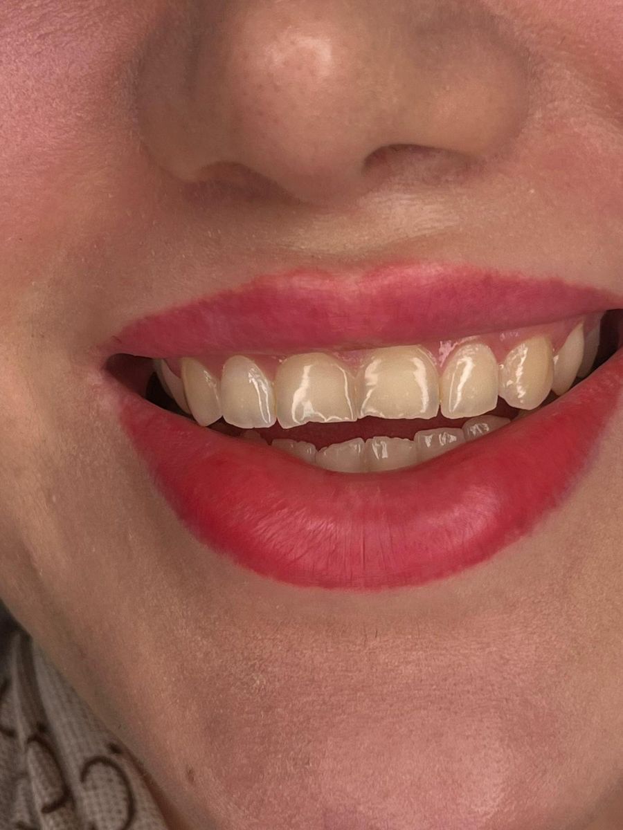 Composite bonding case 1, before treatment