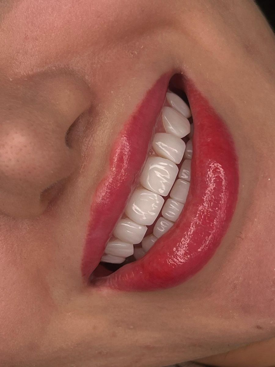 Composite bonding case 1, after treatment