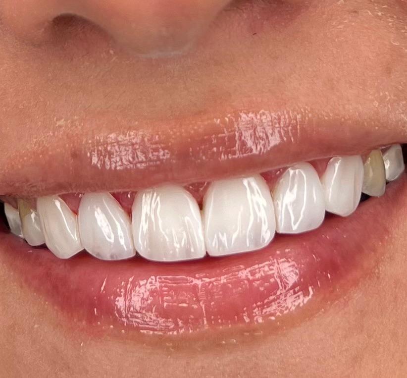Composite bonding case 2, after treatment