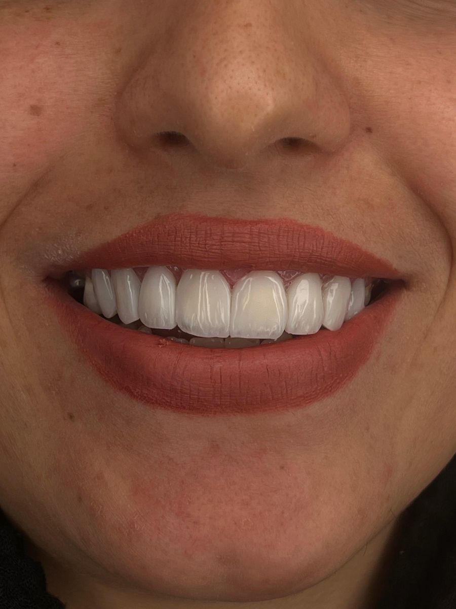 Composite bonding case 3, after treatment