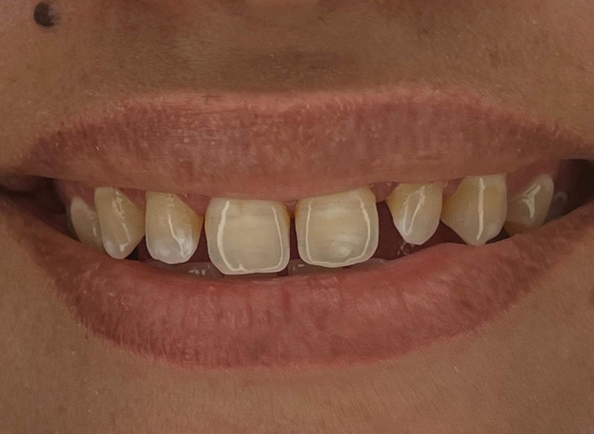 Composite bonding case 4, before treatment