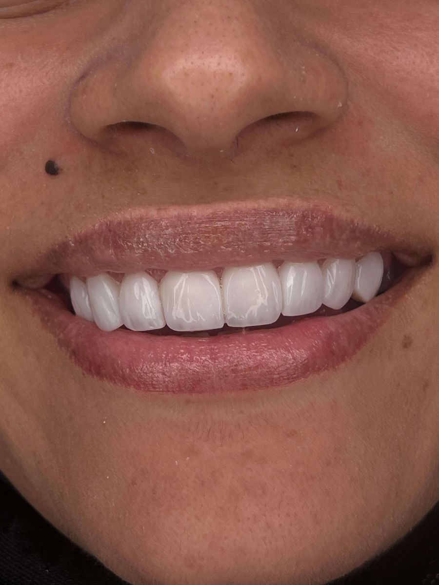 Composite bonding case 4, after treatment