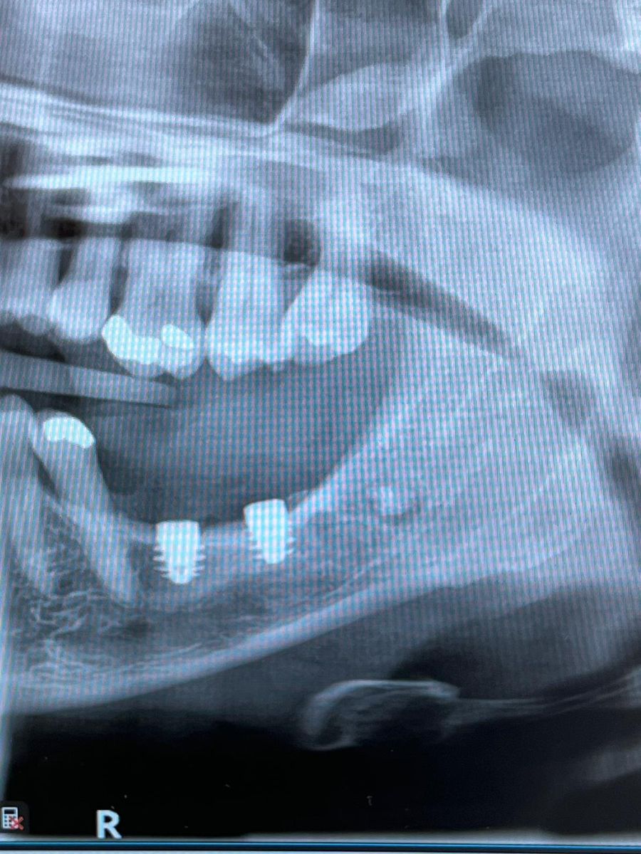 Dental implant case 1, stage 4 of 4